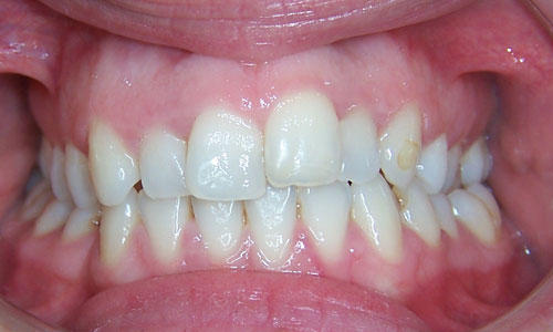 Patient smile before orthodontic treatment (case 52)