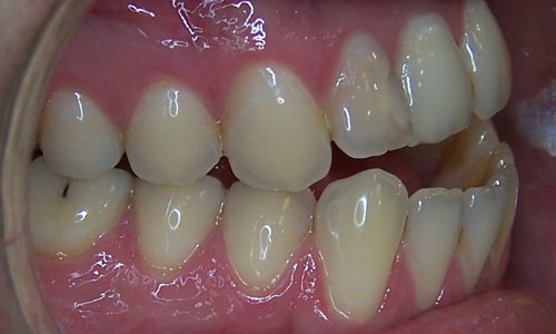 Patient smile before orthodontic treatment (case 13)