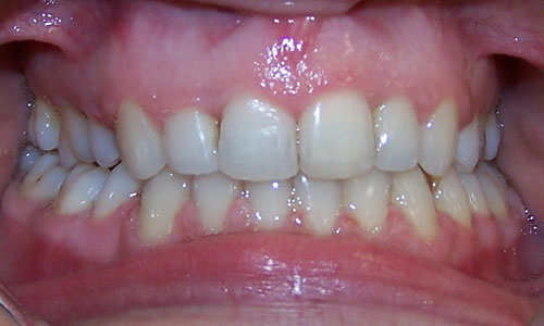 Patient smile after orthodontic treatment (case 52)