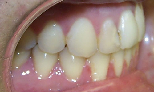 Patient smile after orthodontic treatment (case 13)