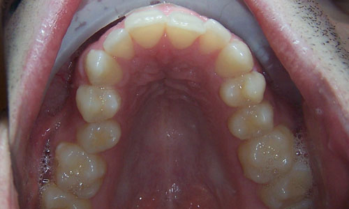 Patient smile before orthodontic treatment (case 14)