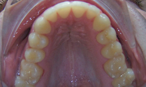 Patient smile after orthodontic treatment (case 14)