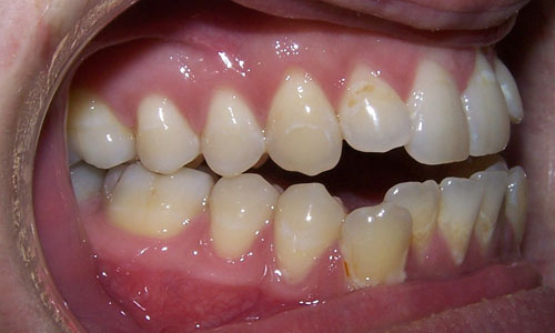 Patient smile before orthodontic treatment (case 15)