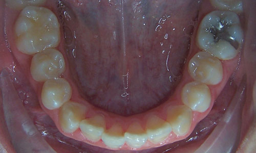 Patient smile before orthodontic treatment (case 53)