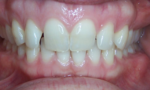 Patient smile before orthodontic treatment (case 36)