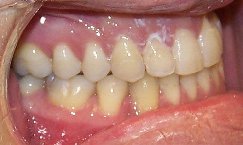 Patient smile after orthodontic treatment (case 15)