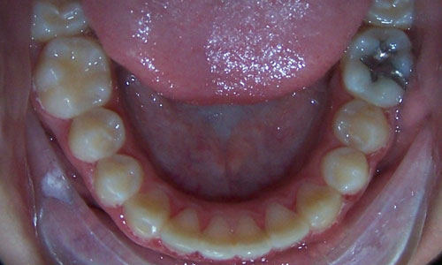 Patient smile after orthodontic treatment (case 53)