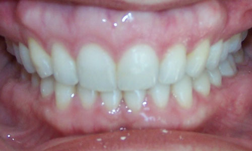 Patient smile after orthodontic treatment (case 36)