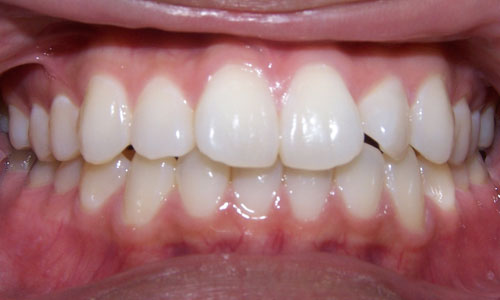 Patient smile before orthodontic treatment (case 16)
