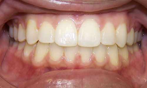 Patient smile after orthodontic treatment (case 16)