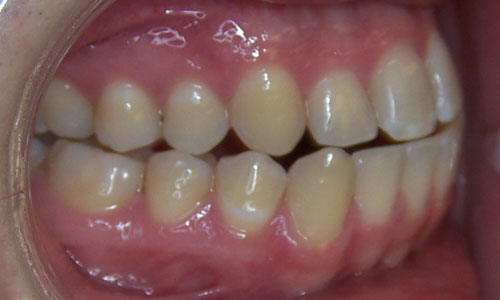 Patient smile before orthodontic treatment (case 17)