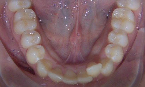 Patient smile before orthodontic treatment (case 54)