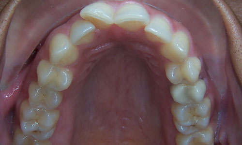 Patient smile before orthodontic treatment (case 37)