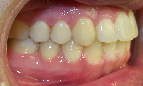Patient smile after orthodontic treatment (case 17)
