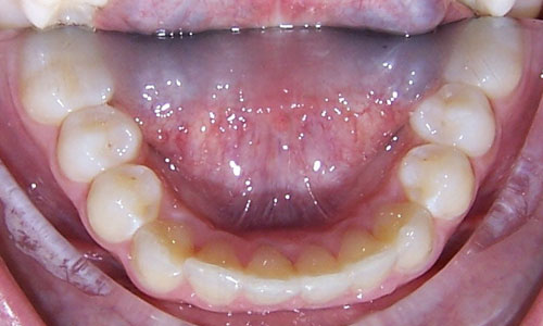 Patient smile after orthodontic treatment (case 54)