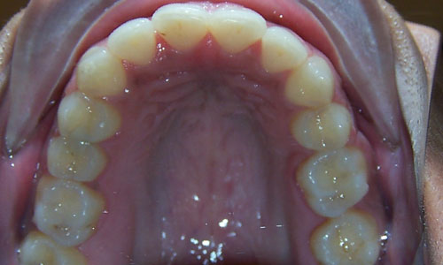 Patient smile after orthodontic treatment (case 37)