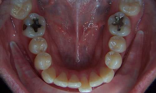 Patient smile before orthodontic treatment (case 55)