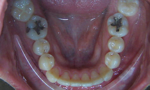 Patient smile after orthodontic treatment (case 55)