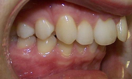 Patient smile before orthodontic treatment (case 18)
