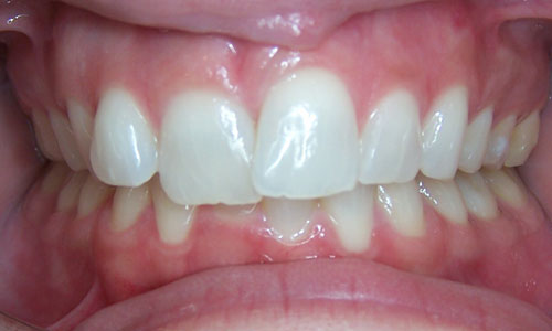 Patient smile before orthodontic treatment (case 56)