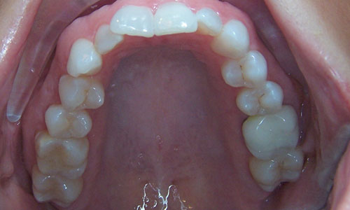 Patient smile before orthodontic treatment (case 38)