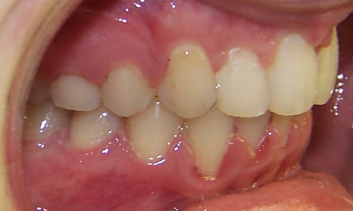 Patient smile after orthodontic treatment (case 18)