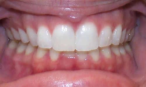 Patient smile after orthodontic treatment (case 56)