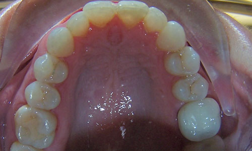 Patient smile after orthodontic treatment (case 38)