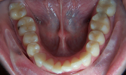 Patient smile before orthodontic treatment (case 57)