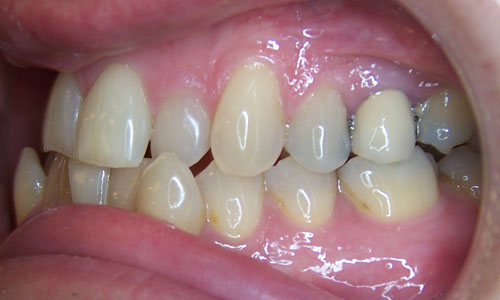 Patient smile before orthodontic treatment (case 19)