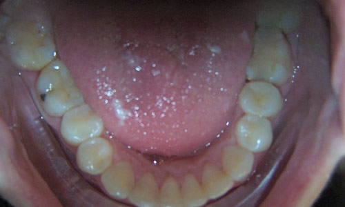 Patient smile after orthodontic treatment (case 57)