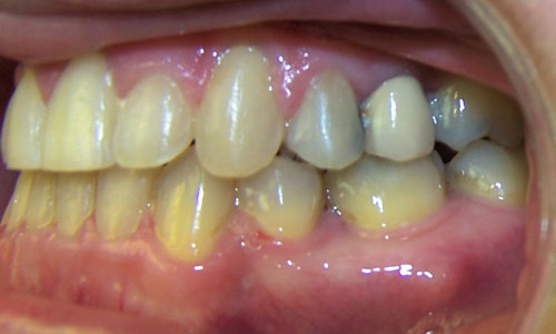 Patient smile after orthodontic treatment (case 19)