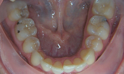 Patient smile before orthodontic treatment (case 58)