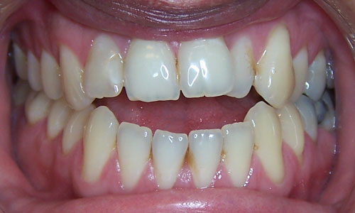 Patient smile before orthodontic treatment (case 20)