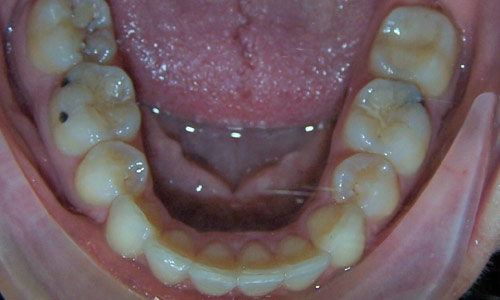 Patient smile after orthodontic treatment (case 58)
