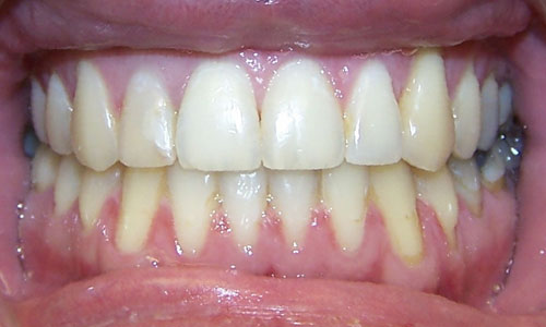 Patient smile after orthodontic treatment (case 20)