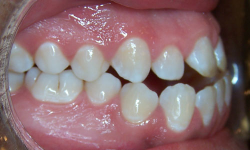 Patient smile before orthodontic treatment (case 21)