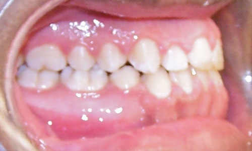Patient smile after orthodontic treatment (case 21)