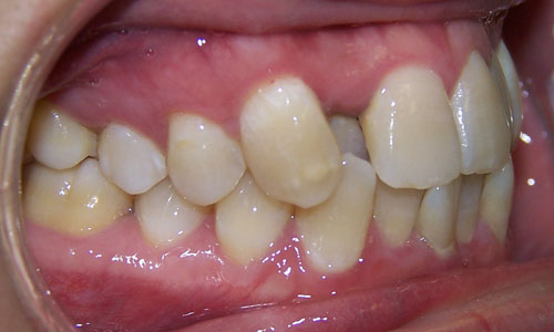 Patient smile before orthodontic treatment (case 22)