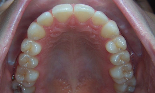 Patient smile before orthodontic treatment (case 59)