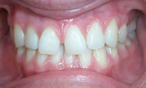 Patient smile before orthodontic treatment (case 39)