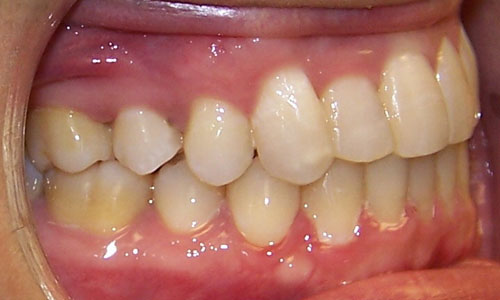 Patient smile after orthodontic treatment (case 22)