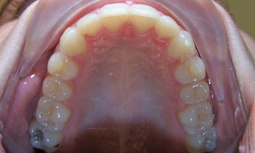 Patient smile after orthodontic treatment (case 59)