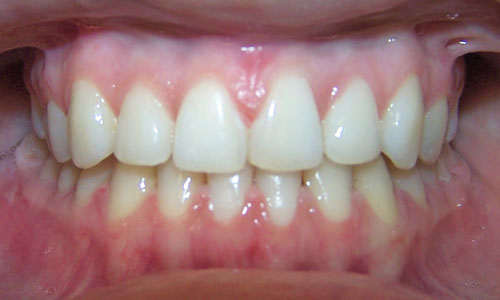 Patient smile after orthodontic treatment (case 39)