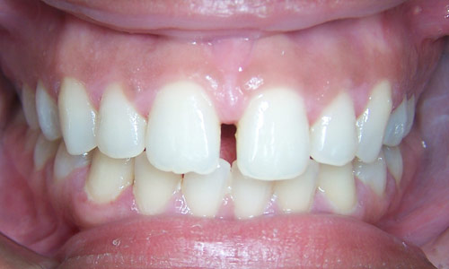 Patient smile before orthodontic treatment (case 60)