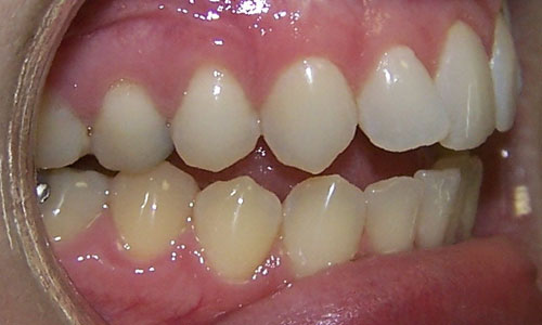 Patient smile before orthodontic treatment (case 23)