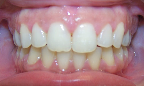 Patient smile after orthodontic treatment (case 60)