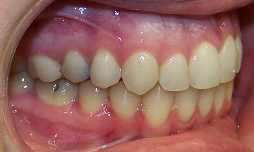 Patient smile after orthodontic treatment (case 23)