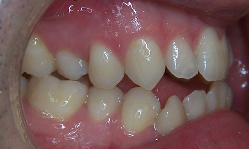 Patient smile before orthodontic treatment (case 24)