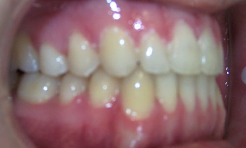 Patient smile after orthodontic treatment (case 24)